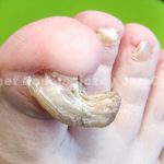 Onychogryphosis