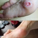 Hallux Valgus-wound healing