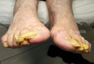 Onychogryphosis (1)