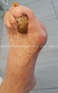 Szponowate paznokcie