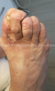 Paznokcie po zabiegu